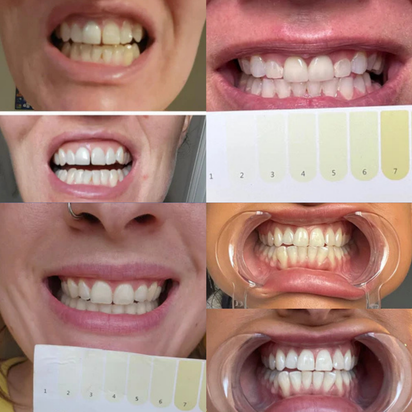 Stralende Glimlach Whitening Strips